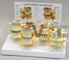 Vertebrae 4 pc Lumbar Spine Disc Model